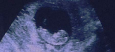 This ultrasound is going viral (for a freaky reason)