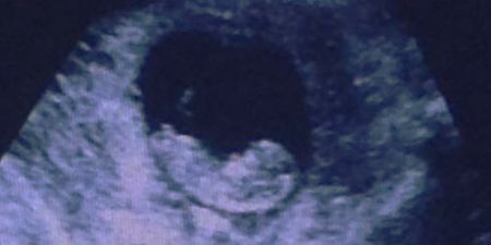 This ultrasound is going viral (for a freaky reason)