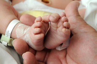 Conjoined Twins to Undergo Landmark Surgery