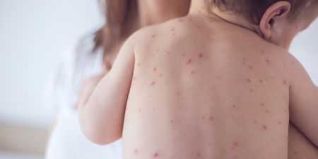 HSE Issues Warning Following Outbreak of Measles in Different Parts of Ireland