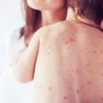 10 things you might not have known about the chicken pox