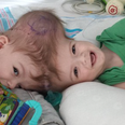 Conjoined Twin Boys Successfully Separated At New York Hospital