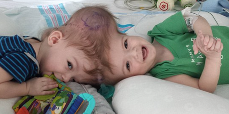 Conjoined Twin Boys Successfully Separated At New York Hospital