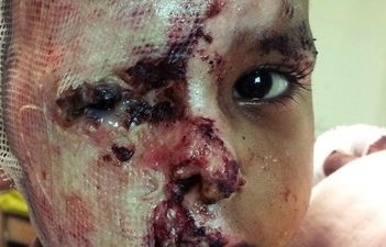 INDIA: 2-Year-Old Covered In Acid And Dumped ‘In Revenge Attack’