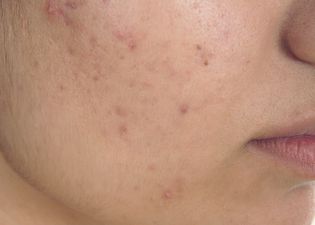 People are raving about this natural ingredient that can massively help acne