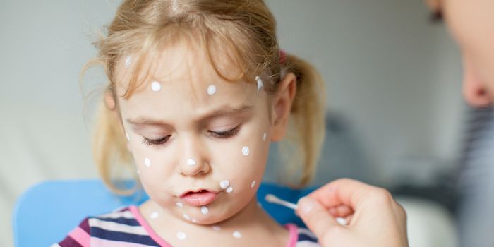 Calls for chickenpox vaccine to be made available for all children in Ireland