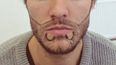 Beard transplants are a thing (and a reality TV star just paid A LOT of cash for one)