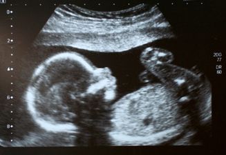 Miscarriage: ‘I had to tell my friends that I had been pregnant… but now I wasn’t’