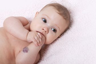 Everything you need to know about moles and birthmarks