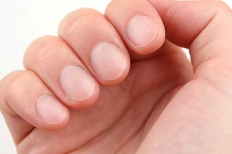 Woman’s Facebook warning that this nail change can indicate cancer