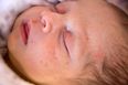 6 natural remedies to soothe your child’s eczema