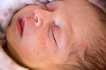 6 natural remedies to soothe your child’s eczema