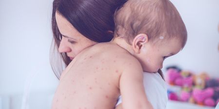 Things you should (and shouldn’t) do if your child gets a dose of chicken pox