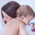 HSE issues measles warning over two new cases in Dublin