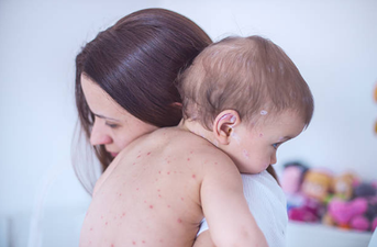 The number of measles cases in Europe rose by 400 per cent last year