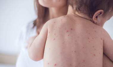 Measles: Symptoms to look out for and how it can be treated