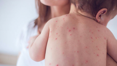 18 of the 20 diagnosed in Limerick’s measles outbreak were unvaccinated