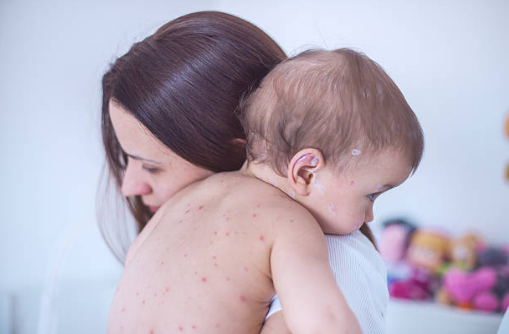 Early symptoms of measles as health officials warn of another rise in cases in Ireland