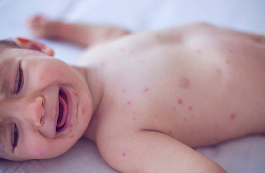 There is a mumps outbreak in the west of Ireland, HSE confirms