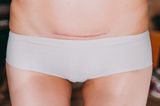 Viral video shows exactly what a person goes through when they have a c-section