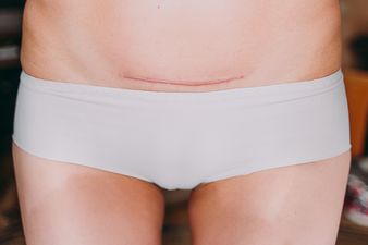 Viral video shows exactly what a person goes through when they have a c-section