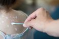 Parents urged to avoid hosting ‘chicken pox parties’ for children