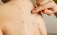 Parents urged to be wary as five measles cases confirmed in Dublin