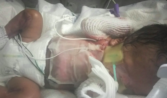 Three-month-old baby born without most of his skin now in stable condition