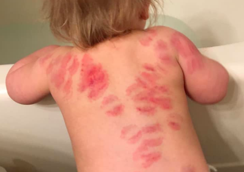 Mum’s horror at finding at least 25 bite marks on daughter’s body after picking her up from nursery