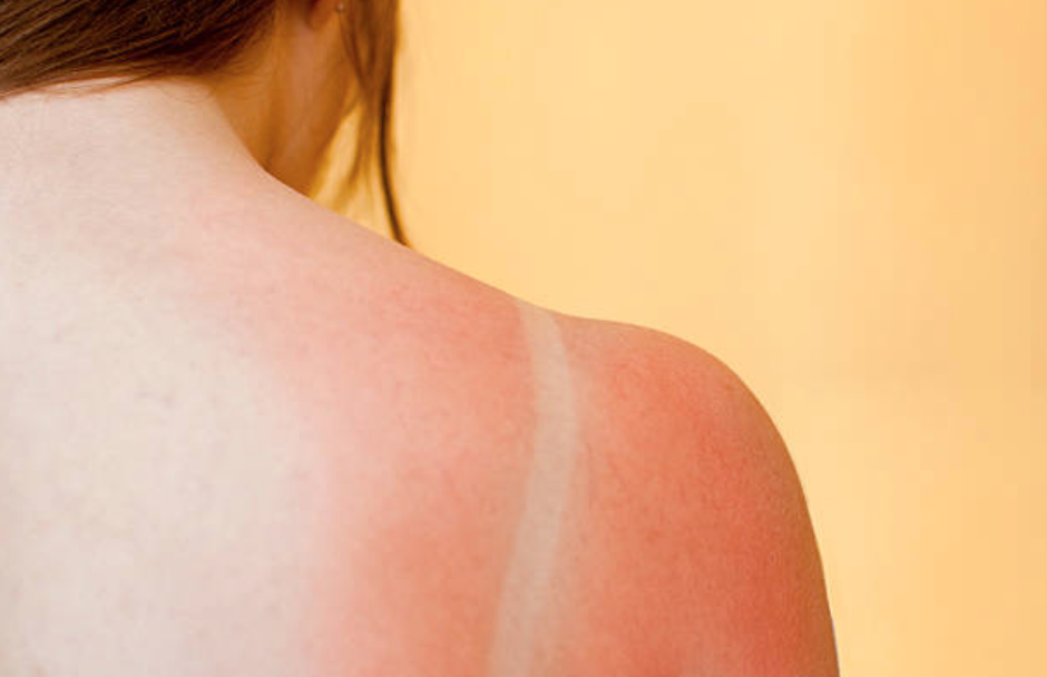 Got some sun yesterday? An Irish pharmacist shares the best ways to heal sunburn