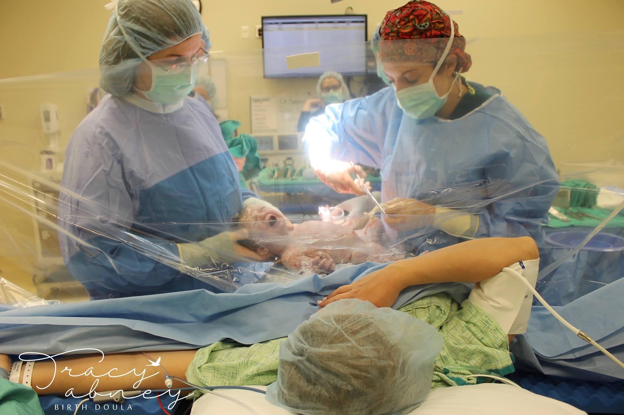 A ‘Clear drape C-section’ allows people see their cesarean birth happening