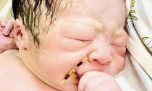 baby born holding mother's contraceptive coil