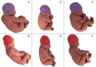 Women give birth in MRI to show baby’s head change shape in labour