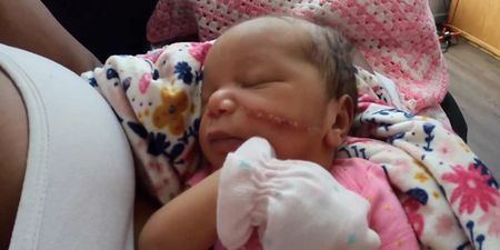 Newborn needs 13 stitches on her face after being “sliced” during emergency C-section
