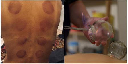 I tried the cupping therapy popular with celebrities  – and here is what happened
