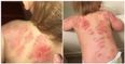 Horrified mum discovers her toddler is covered in bitemarks after a day in creche