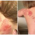Horrified mum discovers her toddler is covered in bitemarks after a day in creche