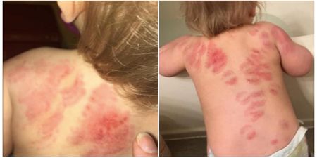 Horrified mum discovers her toddler is covered in bitemarks after a day in creche