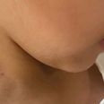 Mum shocked to find hickeys on bullied 6-year-old’s neck after school