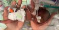 Tiny baby born in 2020 named the world’s most premature to survive