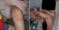 Cork mam warns parents after 1-year-old son is hospitalised with Covid-related rash