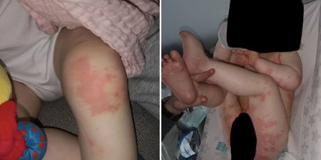 Cork mam warns parents after 1-year-old son is hospitalised with Covid-related rash