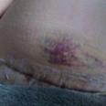 Mum shares photo of C Section scar to prove it is not the ‘easy way out’