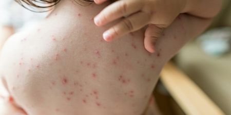 Concerns about increase in chickenpox cases in Ireland