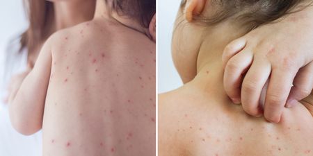 Warning to Irish parents following chickenpox outbreak