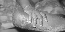 Only a matter of time before monkeypox spreads to Ireland