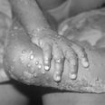 What exactly is monkeypox and is it dangerous?