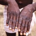 Parents told not to worry about monkeypox as cases are rare in children