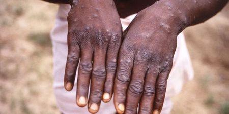 Parents told not to worry about monkeypox as cases are rare in children