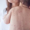 Chickenpox vaccine will likely be added to childhood immunisation programme